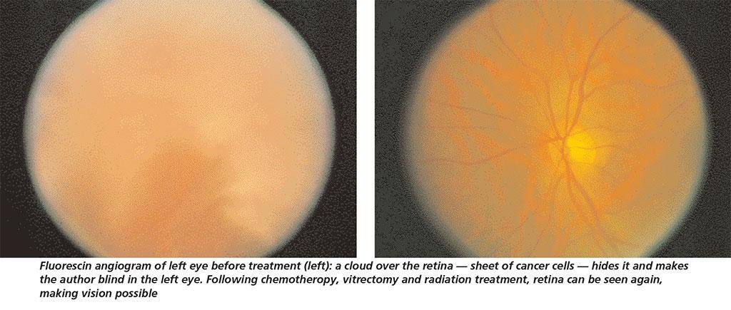 Fluorescin angiogram of left eye before treatment (left): a cloud over the retina — sheet of cancer cells — hides it and makes the author blind in the left eye. Following chemotheropy, vitrectomy and radiation treatment, retina can be seen again, 
making vision possible